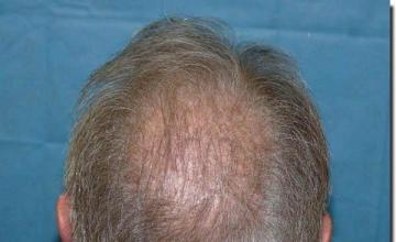 Hair restoration procedure results