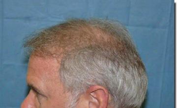 Hair restoration procedure results