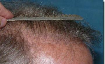 Hair restoration procedure results