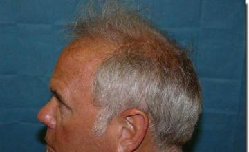 Hair restoration procedure results