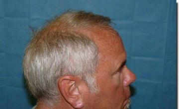 Hair restoration procedure results