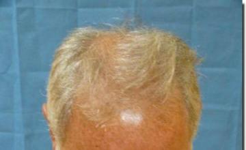 Hair restoration procedure results