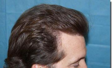 Hair restoration procedure results