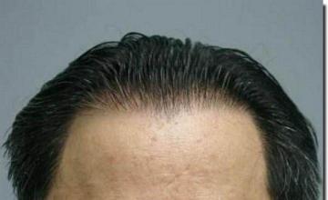 Hair restoration procedure results