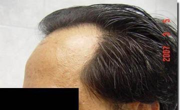 Hair restoration procedure results