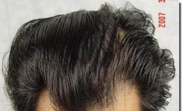 Hair restoration procedure results