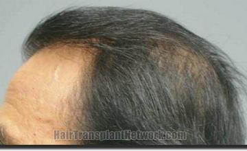 Hair restoration procedure results