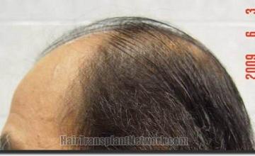 Hair restoration procedure results