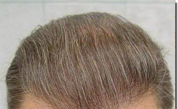 Hair restoration procedure results