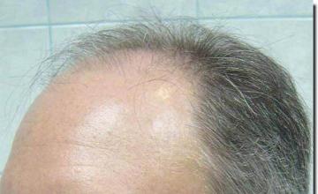 Hair restoration procedure results