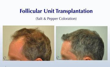 Hair transplantation surgery before and after photos