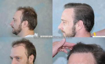 Hair transplantation surgery before and after pictures