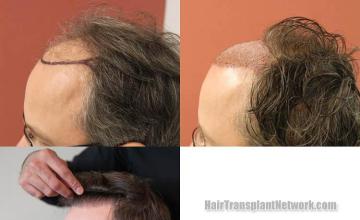 Hair transplantation surgery before and after images