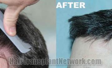 Hair transplantation surgery before and after images