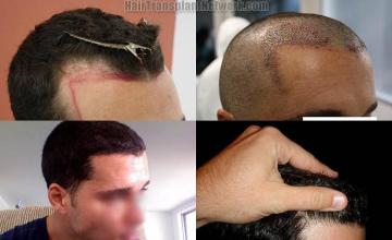 Hair transplantation surgery before and after photos