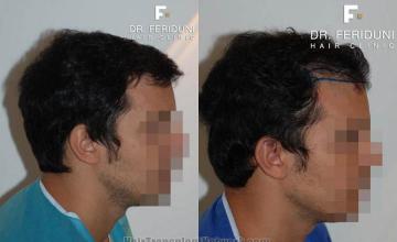 Hair transplantation surgery before and after images