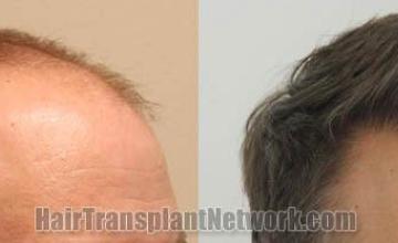 Hair transplantation surgery before and after pictures