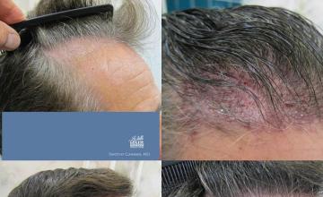 Hair transplantation surgery before and after pictures