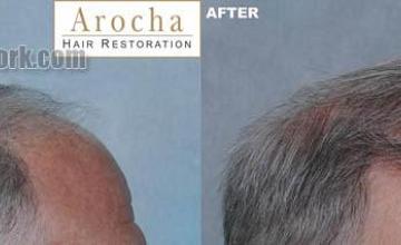 Hair transplantation surgery before and after pictures