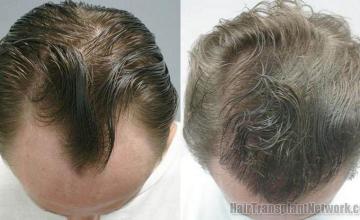 Hair restoration photos - Top view