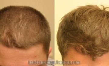 Top view before and after hair restoration results