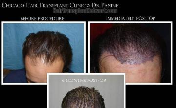 Hair transplantation surgery before and after photos