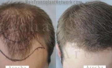 Hair restoration procedure before and after results