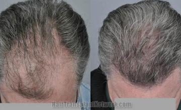 Hair transplantation surgery before and after photos