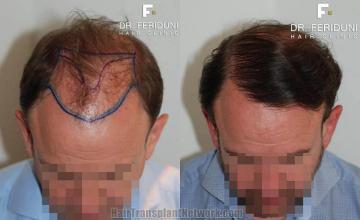 Top view before and after hair restoration results