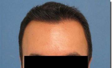 Hair restoration procedure results