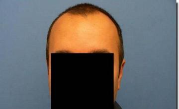 Hair restoration procedure results