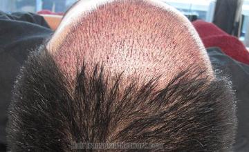 Hair restoration procedure before and after pictures