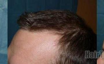 Hair restoration procedure results