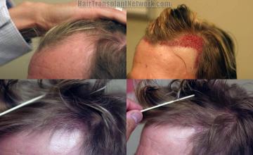 Hair transplantation surgery before and after images