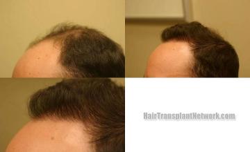 Surgical hair transplantation result photographs