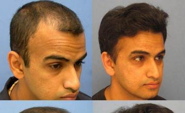 Right  side photos displaying hair transplant results