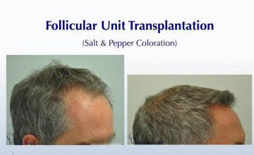 Hair restoration procedure before and after results