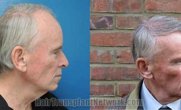 Hair transplantation surgery before and after photos