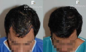 Hair transplantation surgery before and after photos