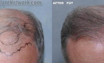 Hair transplantation surgery before and after images