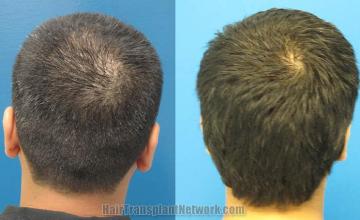 Hair transplantation surgery before and after images