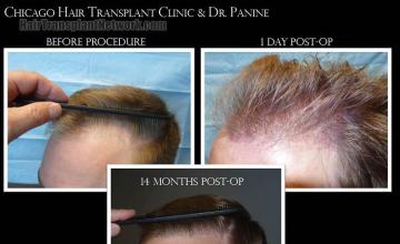 Hair transplantation surgery before and after pictures