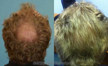 Back view before and after hair transplantation photos