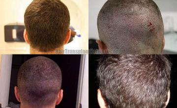 Hair transplantation surgery before and after pictures