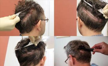 Hair transplantation surgery before and after pictures