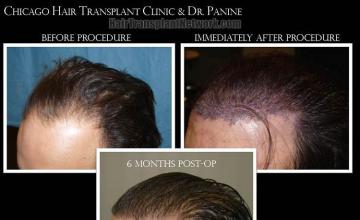 Hair transplantation surgery before and after pictures