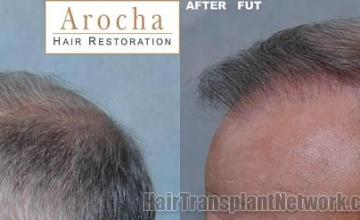 Hair restoration procedure before and after pictures