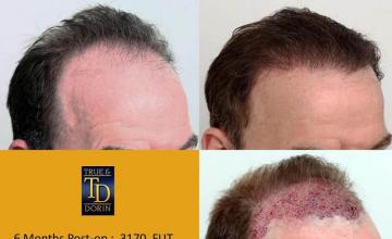 Hair transplantation surgery before and after images