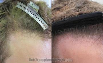 Hair transplantation surgery before and after pictures