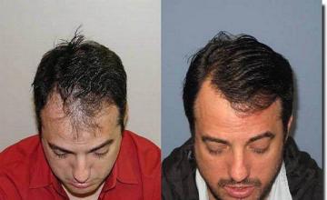 Hair restoration procedure results